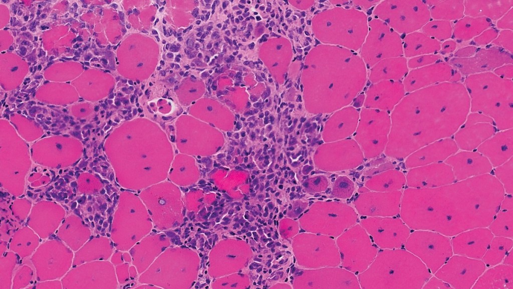 Binghamton University research study advances treatment for Duchenne muscular&nbsp;dystrophy